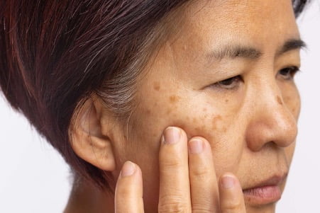 Nám, tàn nhang, sắc tố da luôn là nỗi ám ảnh với các chị em phụ nữ