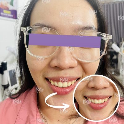 Giải quyết nụ cười hở lợi chỉ trong một nốt nhạc!