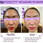 HIFU Ultraformer III - Công nghệ trẻ hóa làn da đỉnh cao BA