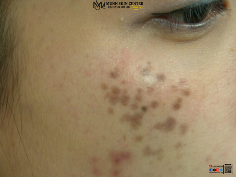 Tình trạng da khi có nám chân sâu